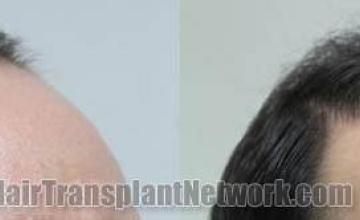 Hair transplantation surgery before and after images