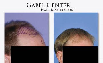 Hair restoration surgery before and after images