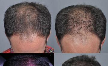 Hair transplantation surgery before and after pictures