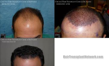 Hair transplantation surgery before and after photos