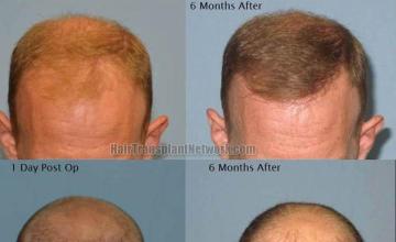 Hair transplantation surgery before and after photos,