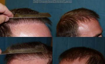 Hair replacement surgery before and after pictures