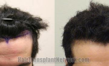 Front images - Before and after 