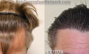 Hair transplantation surgery before and after pictures