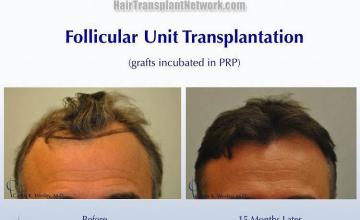 Before and after hair transplant procedure images