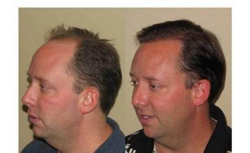 Left view - Before and after hair transplant