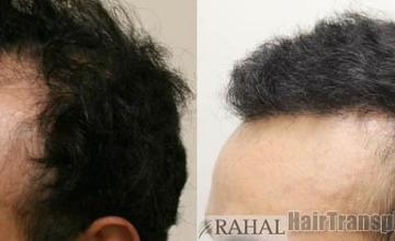 Hair restoration procedure before and after pictures