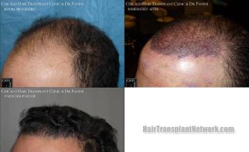 Hair transplantation surgery before and after pictures