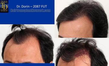 Hair transplantation surgery before and after pictures