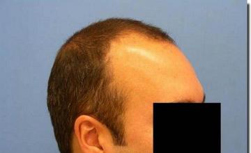 Hair restoration procedure results