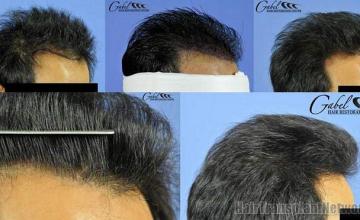 Hair transplant procedure - Right side views.