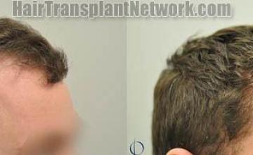 Hair transplantation surgery before and after images