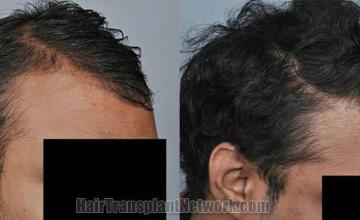 Hair restoration procedure before and after results