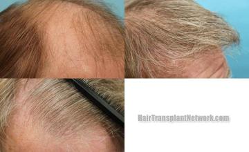 Hair transplantation surgery before and after pictures