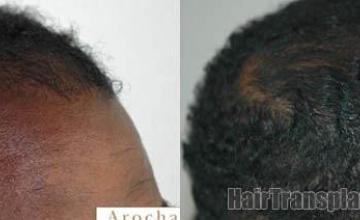 Hair restoration procedure before and after results