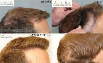 Hair transplantation surgery before and after images