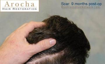 Surgical hair transplantation result photographs