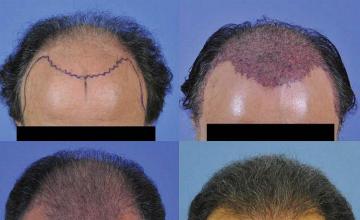 Tilt down angle view of hair replacement surgery