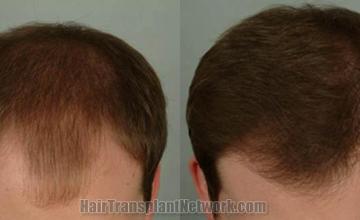 Top view - Before and after surgical hair replacement