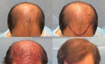 Hair transplantation surgery before and after photos