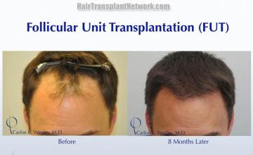 Hair transplantation surgery before and after photos