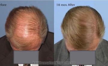 Hair restoration procedure before and 18 months after pictures