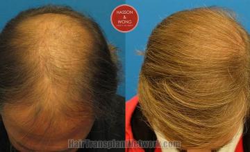 Hair transplantation surgery before and after photos