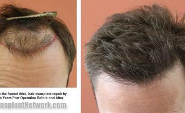 Hair transplantation surgery before and after photos