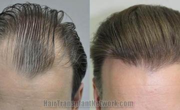 Hair transplantation surgery before and after photos