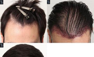 Hair transplantation surgery before and after photos