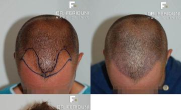 Top view before and after hair restoration results