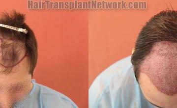 Hair transplantation surgery before and after images