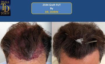 Hair restoration surgery before and after images