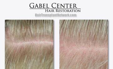 Surgical hair transplantation result photographs