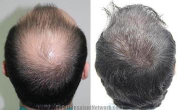 Hair restoration procedure before and after pictures