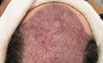 Hair transplantation surgery before and after images