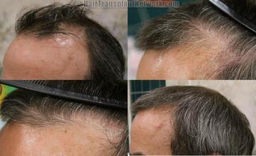 Left view - Hair transplant procedure images