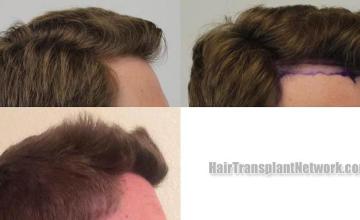 Hair transplantation surgery before and after photos