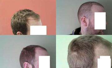 Hair transplantation surgery before and after images