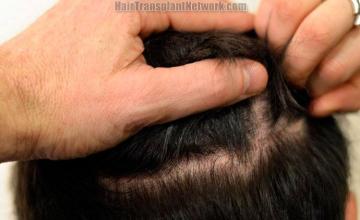 Surgical hair transplantation result photographs