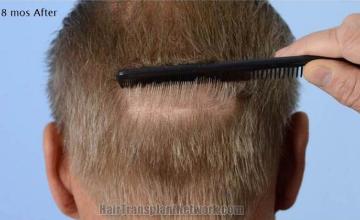 Hair transplantation surgery 18 months after image