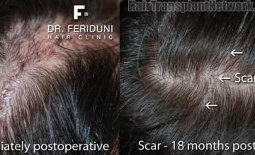 Hair restoration procedure before and after pictures