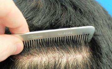 Hair restoration procedure before and after results