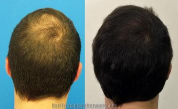 Hair transplantation surgery before and after pictures