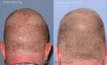 Hair restoration procedure before and after pictures