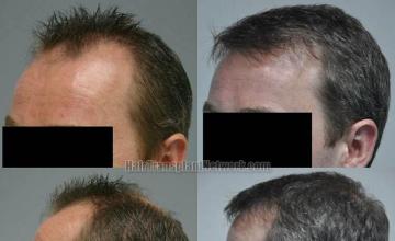 Hair transplantation surgery before and after images