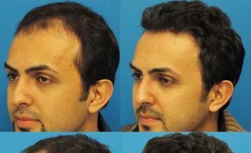 Hair transplantation surgery before and after pictures