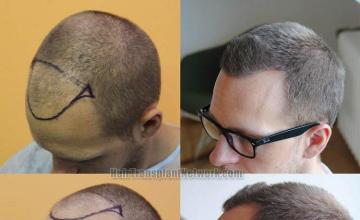 Hair transplantation surgery before and after pictures