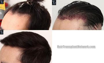 Hair transplantation surgery before and after pictures