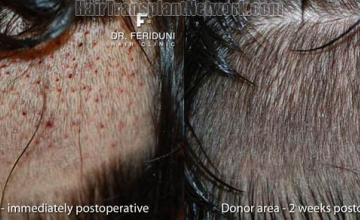 Hair transplantation surgery before and after pictures